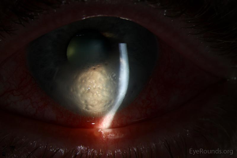Figure 1b: Broad slit beam view of left eye showing microcystic edema and bullae overlying the area of stromal edema.  