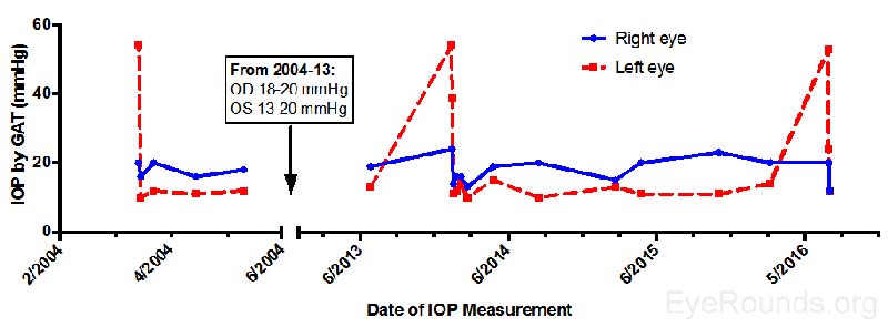 IOP for the patient over several decades with episodes of elevated IOP in 2004, 2014, and 2016. This graph is modeled after a graph by Posner and Schlossman (1984) [1].