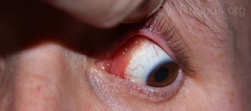 External photo of left eye showing raised, pink caruncular lesion