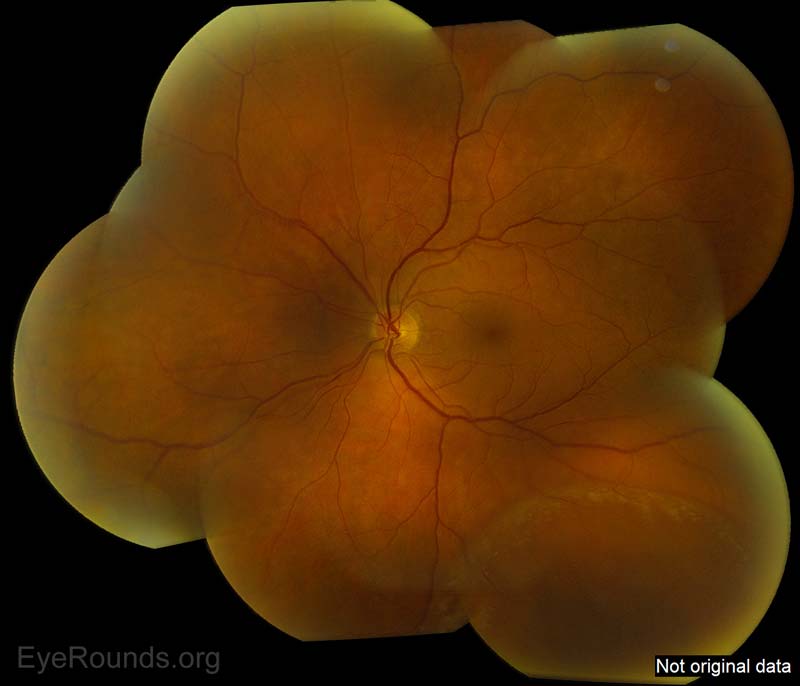 Here is an additional picture of a different patient showing inferotemporal retinoschisis