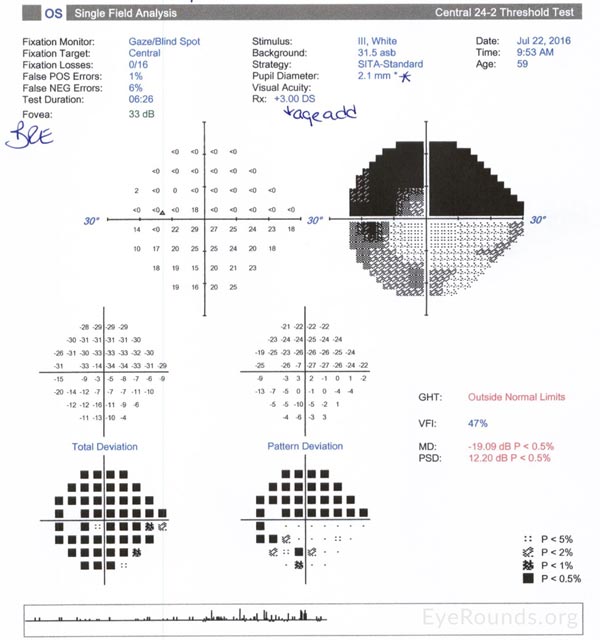 Humphrey Visual field 2402, leftr eye. Dense superior hemifield loss with inferior arcuate defect