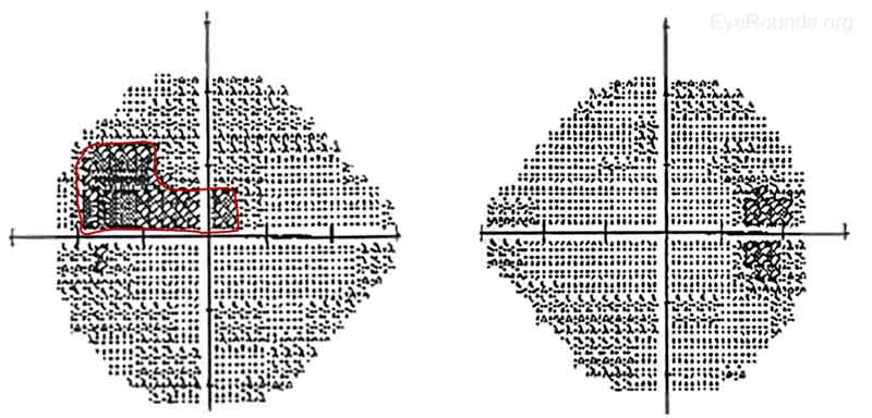 Figure 4: Humphrey Visual Fields 24-2, OU. Right eye- Several inferior and superior nonspecific visual defects, although test reliability was only fair due to 4 out of 11 fixation losses; Mean deviation -6.12dB, Pattern standard deviation 1.75dB. Left eye- Superior field deficit (red) with extension into the central field consistent with optic nerve head swelling inferiorly and subretinal fluid that extended into the macula; Mean deviation -7.88dB, Pattern standard deviation 3.73dB.