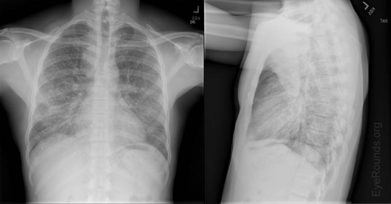 Figure 5: Chest X-ray.  Diffuse interstitial and ground-glass changes throughout both lung fields which appeared symmetric and widely distributed.  No evidence of associated cavitation.  No parapneumonic pleural effusions.  There was evidence of paratracheal lymphadenopathy.