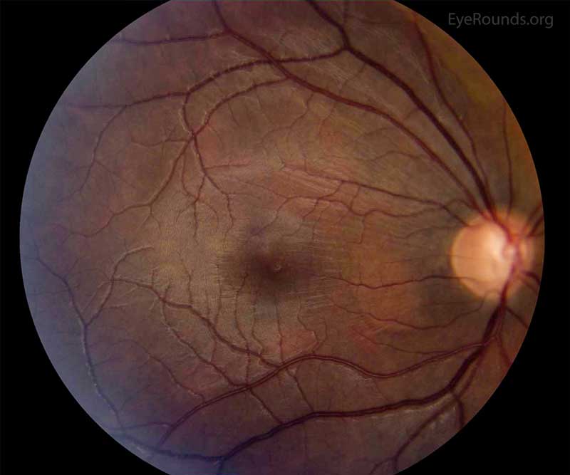 Figure 3:  Color fundus photo of the right eye, centered over the macula. In this photo, the wrinkling and striation of the macula is present from the hypotony maculopathy. Due to the low intraocular pressure, folds form in the chorioretinal tissue. There are fine folds radiating out from the fovea and more prominent folds radiating from the optic disc.