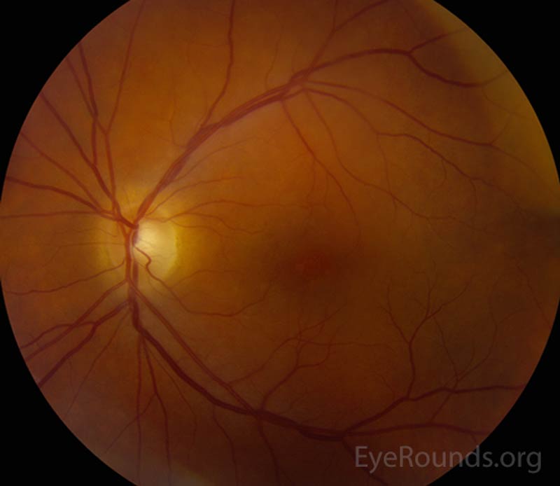 Figure 3: Fundus photos of both eyes. Right eye shows an amelanotic lesion in temporal macula. Left eye was normal. 