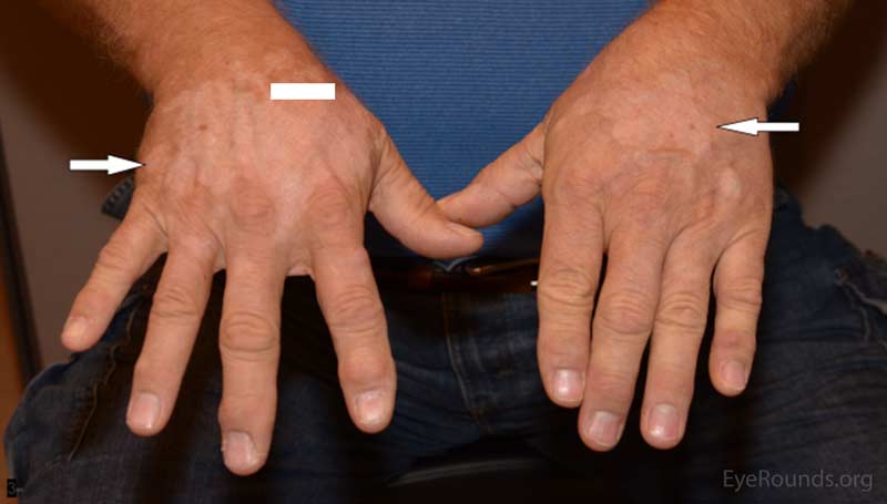 Figure 1: External photos of the hands and face showing depigmented skin lesions (arrows)