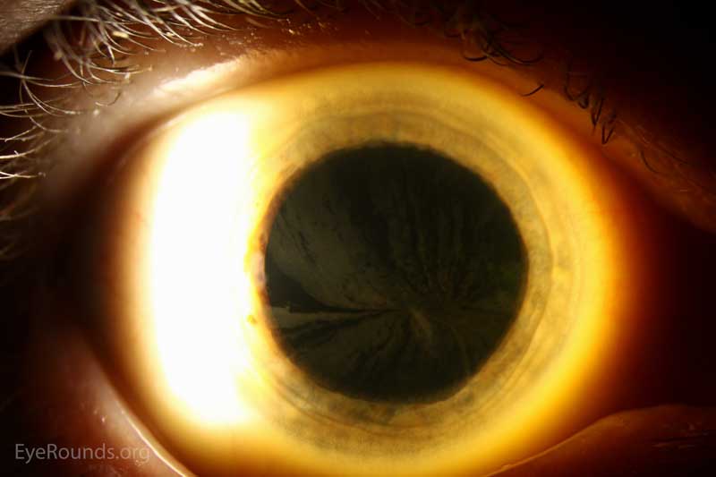Slit lamp photos of the right eye exhibiting the whorled pattern of corneal verticillata