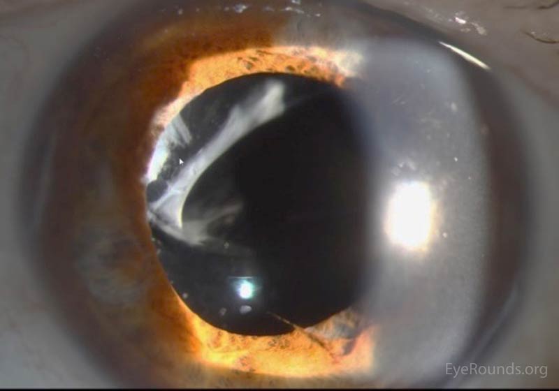 Figure 1: Slit lamp photograph showing 6mm cilium with overlying pigment on the iris at 6 o'clock just nasal to an area of iris atrophy. The cilium extends towards the pupil.