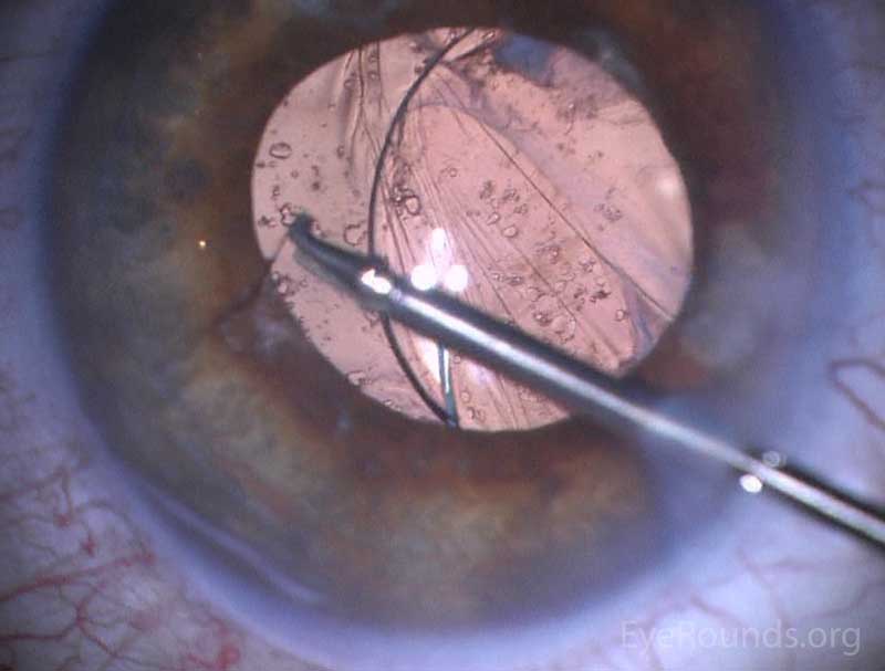 Figure 3: Preoperative (3A) and intraoperative (3B) imaging showing removal of intraocular cilium with duet forceps.  (please see: Intraocular cilium removal following trauma)