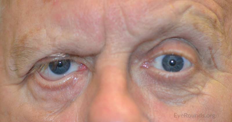External photo at 3 month post-operative visit showing right brow ptosis and lower eyelid ectropion
