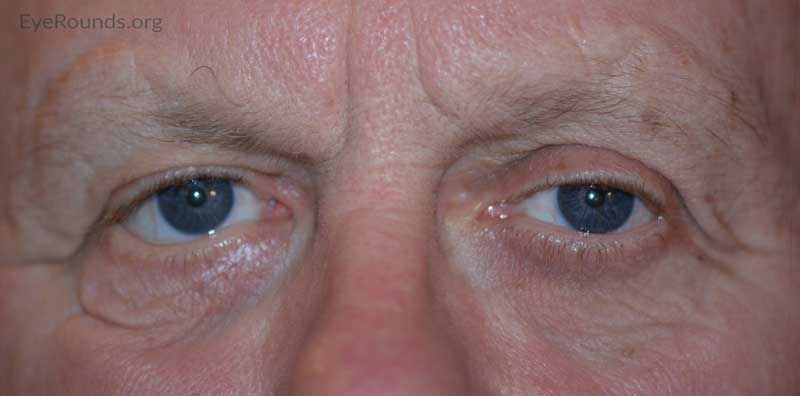 External photo at 6 month post-operative visit showing improved right brow ptosis and lower eyelid ectropion.
