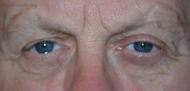 External photo at 18 month post-operative visit showing resolution of right brow ptosis and lower eyelid ectropion, as well as an increased tear lake height.