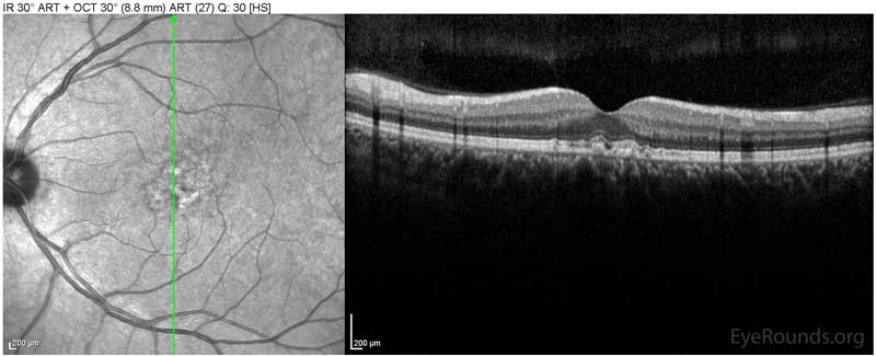 OCT OS Optical coherence tomography of both eyes. In both eyes, there are small drusen above Bruch's membrane without sub- or intraretinal fluid.