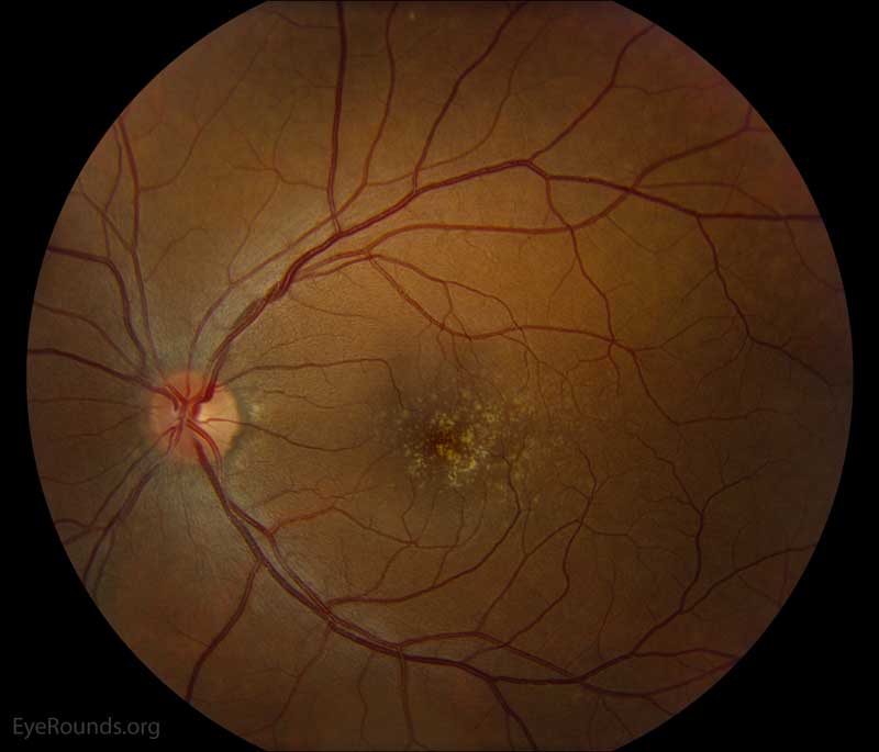 Color fundus photos centered on the macula and montage photos of both eyes. There were multiple small-medium sized, round, yellow drusen, some confluent in the macula and nasal to the nerve in both eyes. There was more clustering of drusen in the temporal macula. A few drusen were near, but not completely abutting the optic nerve. 