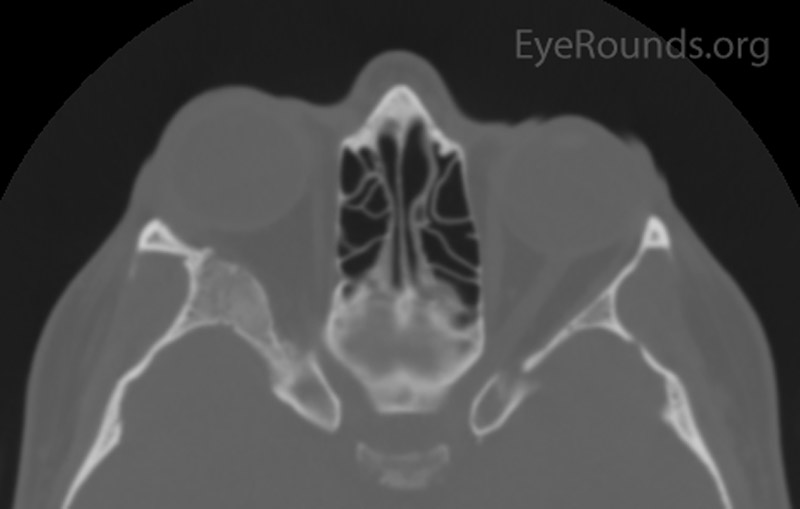 Figure 1: Orbital CT showing expansion of the right greater wing of the sphenoid bone with mottled appearance. (A: coronal view, B: axial view)