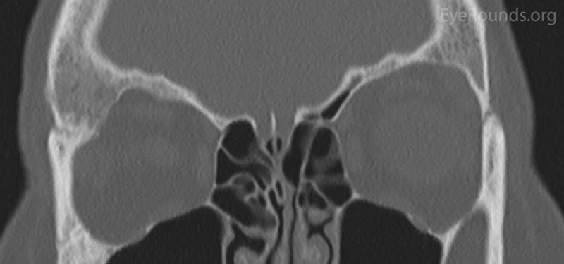 Figure 2: Orbital CT displaying a stable ground glass lesion of right greater wing of the sphenoid. (A: axial, B: coronal)