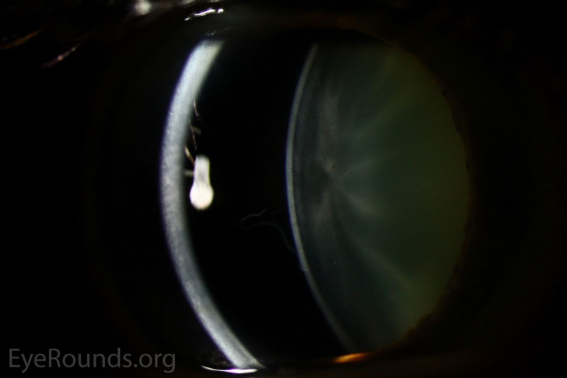 Slit lamp photograph OD with slit beam passing through and outlining the free-floating flap of lens capsule schisis.
