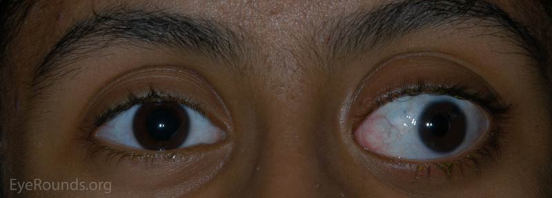 External photograph demonstrating significant buphthalmos, eyelid retraction, and exotropia OS. 
