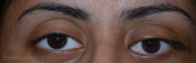 External photograph demonstrating improved eyelid retraction, alignment, and proptosis after orbital decompression and strabismus surgery. 