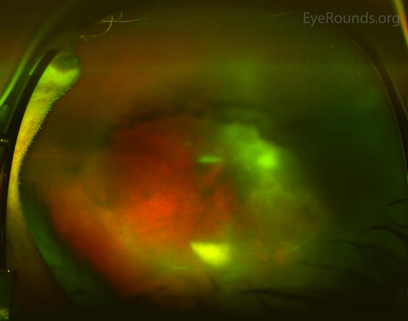 Optos photo of the right eye on presentation demonstrated the significant anterior vitreous cell, dense white vitreous opacities, and very poor view of most of the fundus. 