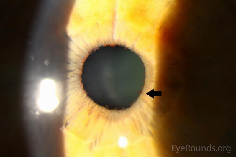 pupillary vascular tufts