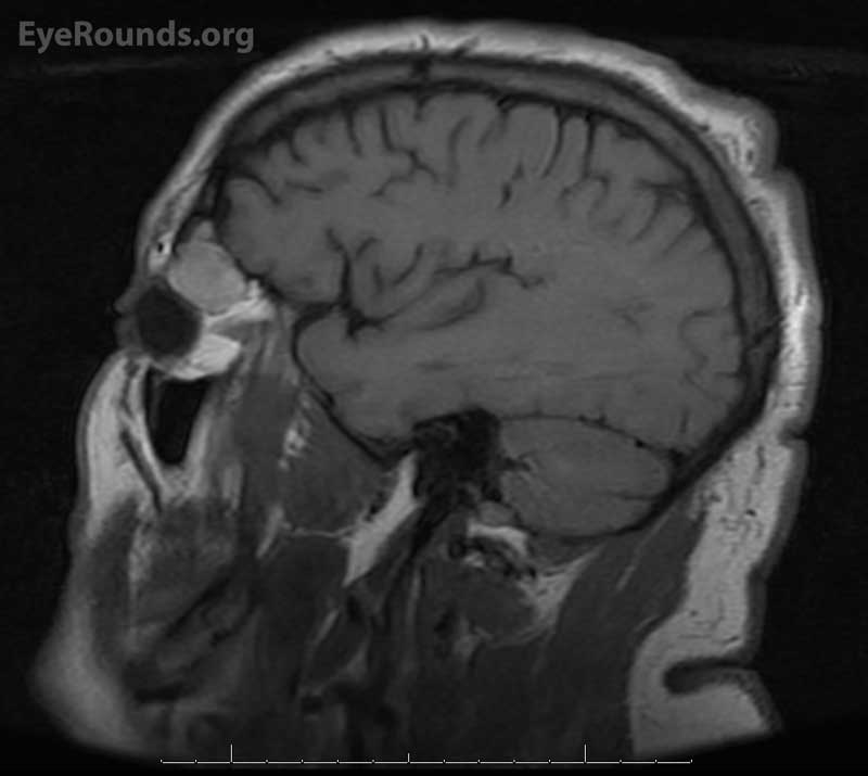 T1 weighted MRI image, sagittal view 