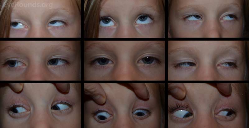 Nine gaze photos demonstrate the patient's excellent alignment in all gazes at post-op week six. 