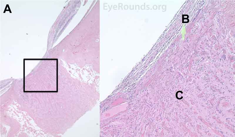 Pathological changes in glaucomatous optic neuropathy secondary to NVG. A- The optic nerve demonstrates severe atrophy and mild gliosis. B- An epiretinal membrane consisting of fibrous appearing cells is present surrounding the disc and over the surface of the disc. C- There is a focal infiltrate of lymphocytes present in the nerve posterior to the lamina cribrosa. The left H&E image (10X) shows the location (black box) of the right image (40X). 