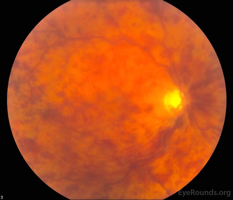 Color fundus photography, both eyes: There were numerous dot-blot heme and flame hemorrhages throughout the macula and mid-periphery of the right eye (left image).