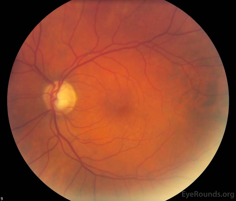 Color fundus photography, both eyes: The left eye (right image) demonstrated a large cup-to-disc ratio but no other retinal abnormalities.