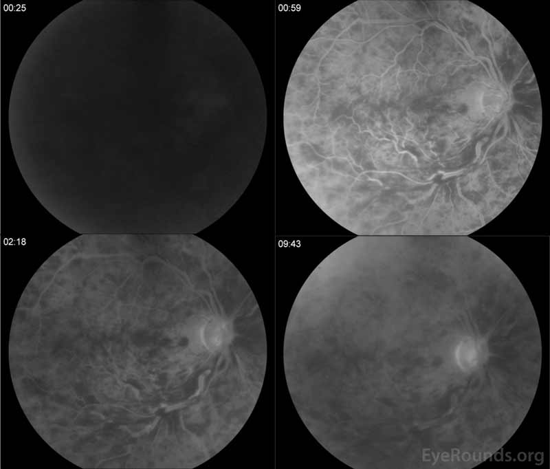 Fundus fluorescein angiography, right eye:  There was evidence of delayed arteriolar filling (top left) with diffuse, late leakage in the macula (bottom images). In these images, it was difficult to evaluate capillary non-perfusion as there was blocking by the numerous retinal hemorrhages.