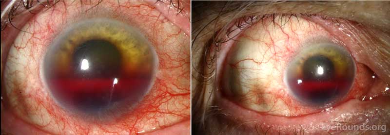 Slit lamp photography, right eye: There was 2+ diffuse injection that was worse at the limbus. The cornea was clear superiorly. A 4 mm hyphema was present with residual neovascularization of the iris along the pupillary margin. 