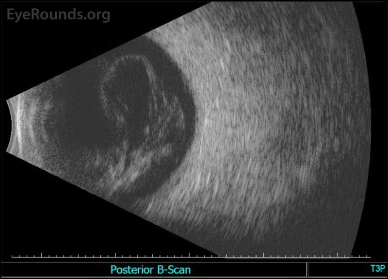 Standardized ocular echography, right eye: Moderate vitreous opacities seen consistent with dense vitreous hemorrhage. No retinal detachment or mass lesion was visualized.