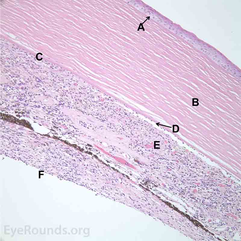 Pathological changes of the cornea and iris in NVG. A- There is a glassy appearance of the cytoplasm of the corneal epithelium suggestive of hydropic degeneration. B- The corneal stroma demonstrates diffuse loss of artifactitious clefting and central significant loss of keratocytes. C- The anterior chamber was flat, and the iris was adherent to the posterior surface of Descemet's membrane, replacing endothelial cells. D- There is severe endothelial cell loss with secondary stromal edema. E- The iris demonstrates florid neovascularization and a moderate infiltrate of lymphocytes and plasma cells. F- There is a necrotic cyclitic membrane present posterior to the iris. The upper hematoxylin and eosin (H&E) image (10X) shows the location (black box) of the lower image (40X).