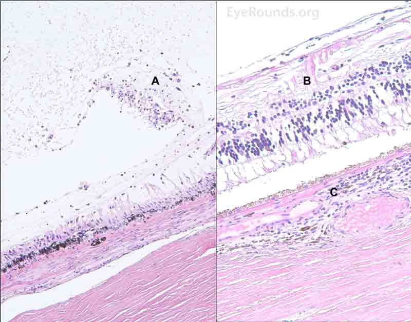 Pathological changes of the vitreous and retina in NVG secondary to an ischemic central retinal vein occlusion. Left H&E image (20X): A- The vitreous cavity demonstrates an anterior fibrillary membrane with old red blood cells and occasional macrophages. Right H&E image (40X): B- The neurosensory retina demonstrates a neovascular membrane in the periphery. The neurosensory retina also demonstrates diffuse loss of cellularity in the inner layers including the ganglion cell layer and the inner nuclear layer. Some gliosis is present in the nerve fiber layer. C- There is a patchy, moderately dense infiltrate of lymphocytes in the choroid.