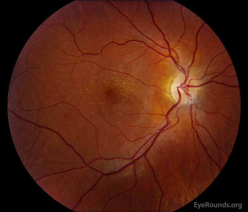 Color fundus photograph, OD (A) shows whitish flecks in the maculae