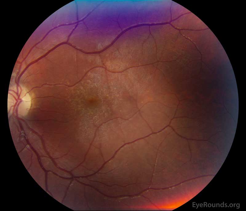 Color fundus photograph, OS (B) show whitish flecks in the maculae