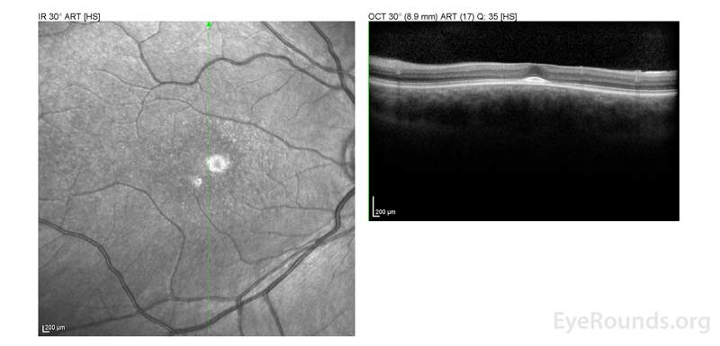 OCT OD (A) and OS(B) show diffuse retinal thinning with parafoveal atrophy of the outer retinal layers.  There is an area of subfoveal hyperreflective foci OU. 