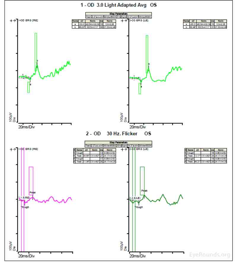 Figure 4C shows low normal light adapted 3.0 cd.s/m2 responses and below normal 30 Hz flicker (cone isolated) responses OU.