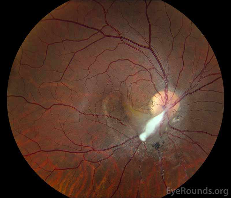 Color Fundus Photograph OD at age 19 status post pars plana vitrectomy demonstrating the amputated stump of the white fibrovascular stalk with resolution of retinal traction. In the area of prior subretinal fluid, there is pigmentary change and clumping, forming what looks like a "watermark."