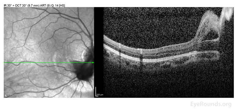 OCT macula at age 19 demonstrating residual schisis of the peripapillary retina just inferior to the optic nerve. The en face infrared (IR) image on the left demonstrates the "water mark" where the peripapillary subretinal fluid resolved following pars plana vitrectomy with release of traction. There was no evidence of persistent subretinal fluid.