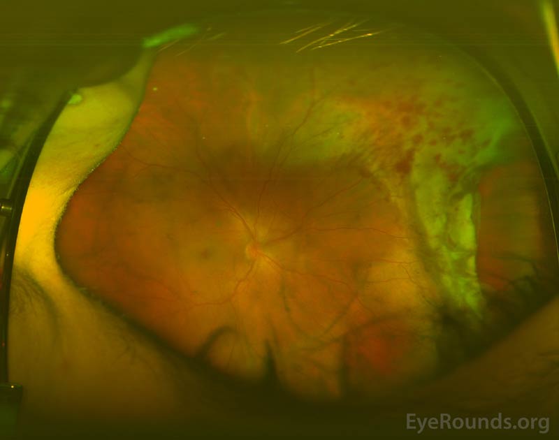 Pseudocolor fundus photograph of the right eye showing mild vitreous hemorrhage, normal appearing nerve and macula, and a retinal dialysis in the nasal periphery with adjacent retinal commotio and intraretinal hemorrhages.