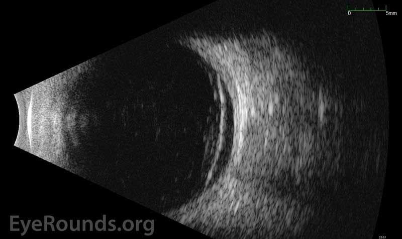 Standardized Echography, OD. Transverse view with nasal quadrant centered at 3 o'clock (T3) showed mild to moderate hyper-echoic signals in the vitreous cavity, which was consistent with vitreous hemorrhage. Anterior to the equator, between 01:00 and 4:30, there was enhancement of vitreous with shallow elevation of the retina extending posterior to the equator. No other areas of retinal detachment were detected. See the ocular ultrasound tutorial for further explanation. 