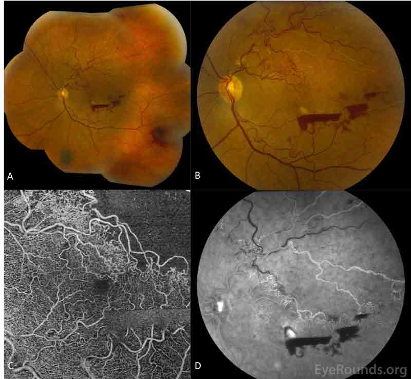 Retinal neovascularization on follow-up examination, OS: The patient had a significant decrease in vision from 20/25 to 20/200 after she missed several appointments.  On fundus exam, there was a recurrence of hemorrhages (A) and persistence of fluid with new regions of NV in the superior macula (B). OCT angiography (OCT-A) was obtained (C), and this image modality showed capillary and large vessel dropout in the superotemporal macula in the region of the prior BRVO. Retinal NV in the inner retina was evident using OCT-A. Fundus fluorescein angiography (D) showed superotemporal non-perfusion with evidence of leakage from NV and collateral vessels in the superior macula in addition to the disc with blockage of stain by the central, preretinal hemorrhages.