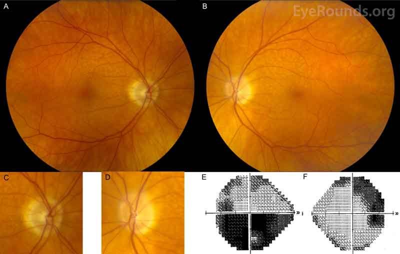 Color fundus photography and Humphrey visual field (HVF) testing, both eyes: A) Right eye has peripapillary atrophy and small macular drusen. B) Left eye had peripapillary atrophy, superior optic nerve pallor with trace edema, and small macular drusen. Higher magnification of the right optic nerve (C) and the left optic nerve (D) are shown. E) HVF testing of the left eye shows an inferior altitudinal defect, which is consistent with an ischemic optic neuropathy. F) HVF testing of the right eye demonstrates a superior arcuate defect extending to blind spot. This is consistent with the patient's previous glaucoma exams.