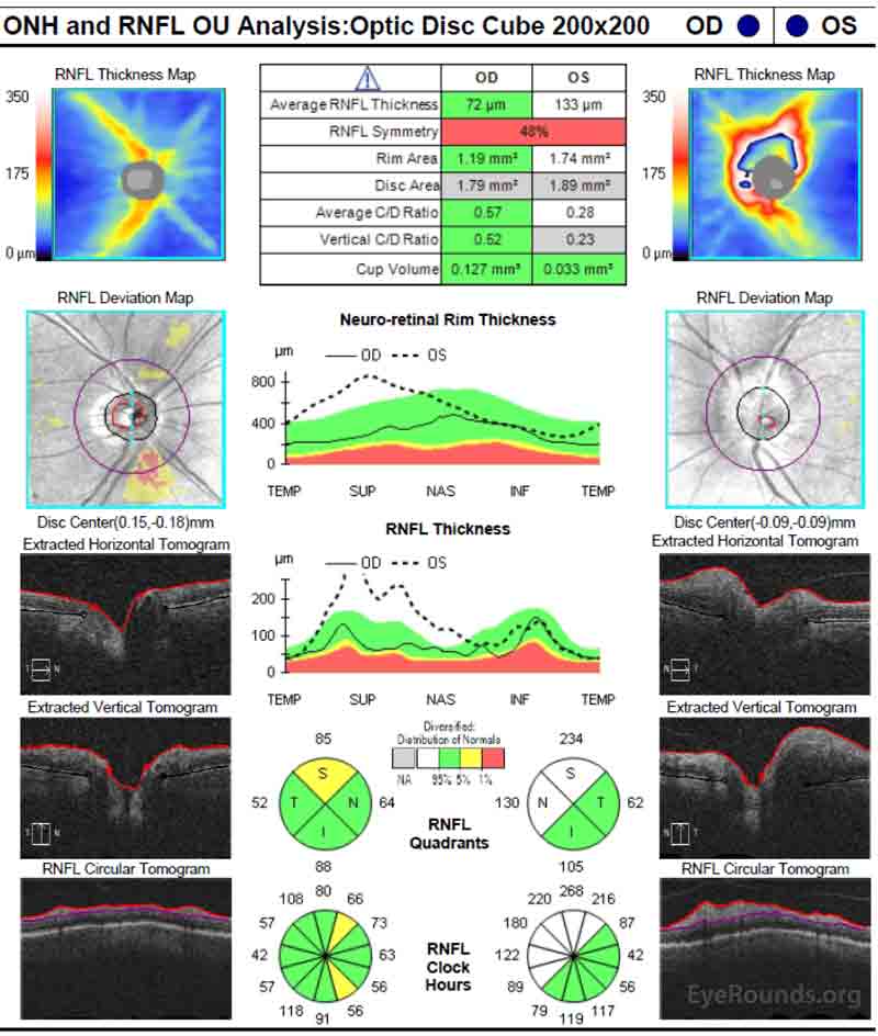 Optic nerve head optical coherence tomography (OCT): There is normal retinal nerve fiber layer thickness with minimal superior thinning OD. The left optic nerve head has increased thickness in the superior and nasal quadrants, which is consistent with disc edema.