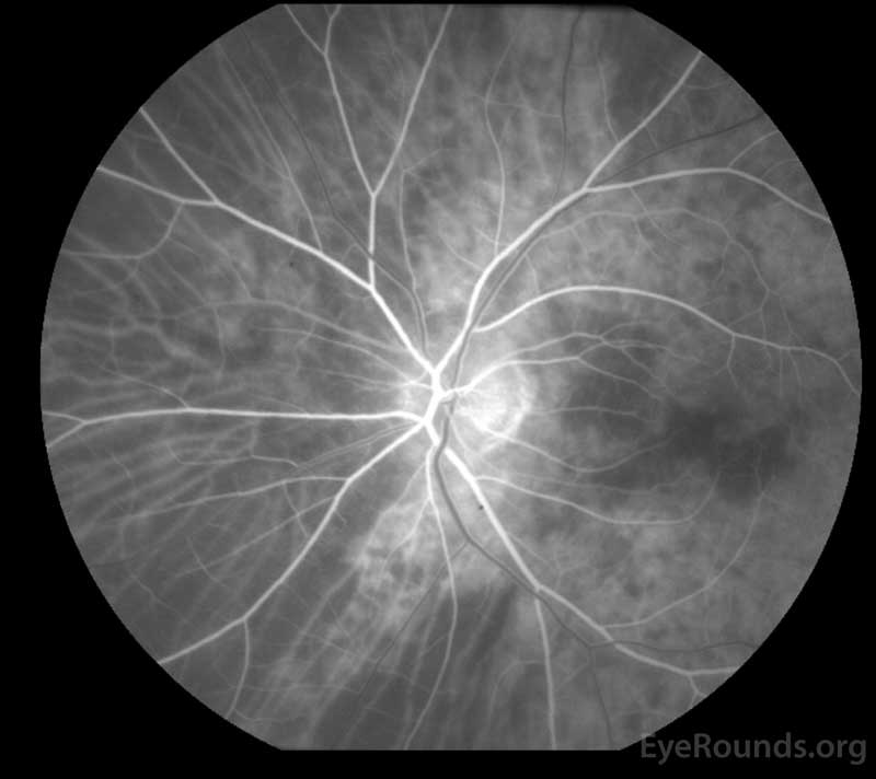 Fluorescein angiography, OS: Left eye fluorescein angiogram shows the lack of choroidal filling in the distribution of the lateral posterior ciliary artery. 
