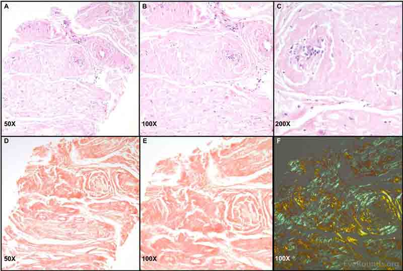 Right lateral rectus biopsy sample with Congo red stain and birefringence. Images A-C: Biopsy sections of the patient's lateral rectus demonstrated fragments of eosinophilic material that appeared largely collagenous. Areas of glassy pink material were present within the tissue. Only a few cells and degenerating muscle fibers were present. Images D and E: Congo red stain was positive throughout most of the tissue. Image F: Apple-green birefringence was identified when the Congo red stained tissue was visualized under polarized light. All tissue samples were processed, stained, and imaged by Dr. Nasreen Syed; these images have been used with her permission. 