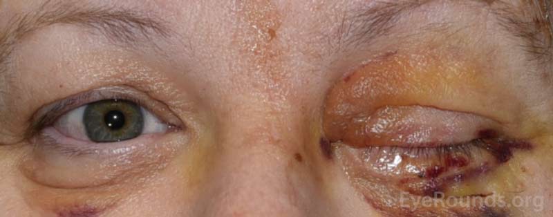 Example of the bruising and swelling that is typical after eye removal surgery. Note that patients often have their eyelid temporarily sewn shut to promote healing.