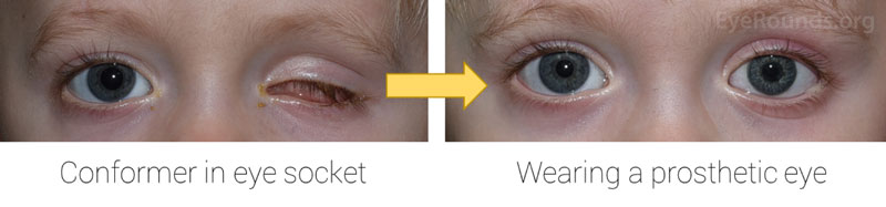 Examples of droopiness seen after the eye removal surgery, which is often corrected after a properly fitted prosthetic eye is worn (top). If the eye continues to be droopy, eyelid adjustment surgery can address the issue (bottom).